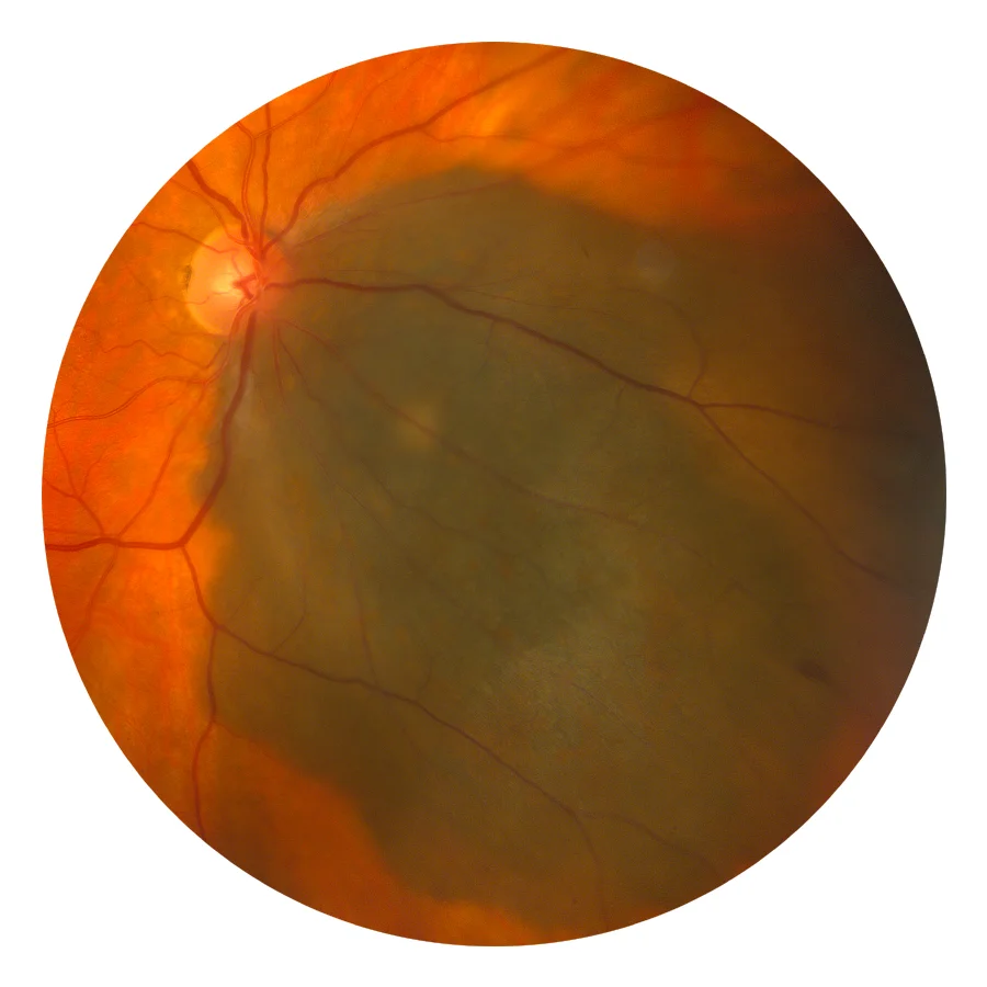 Refer a Patient — THE RETINA INSTITUTE
