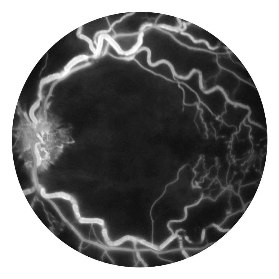 Central Retinal Vein Occlusion