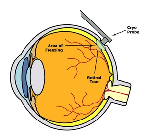 Cryopexy — THE RETINA INSTITUTE