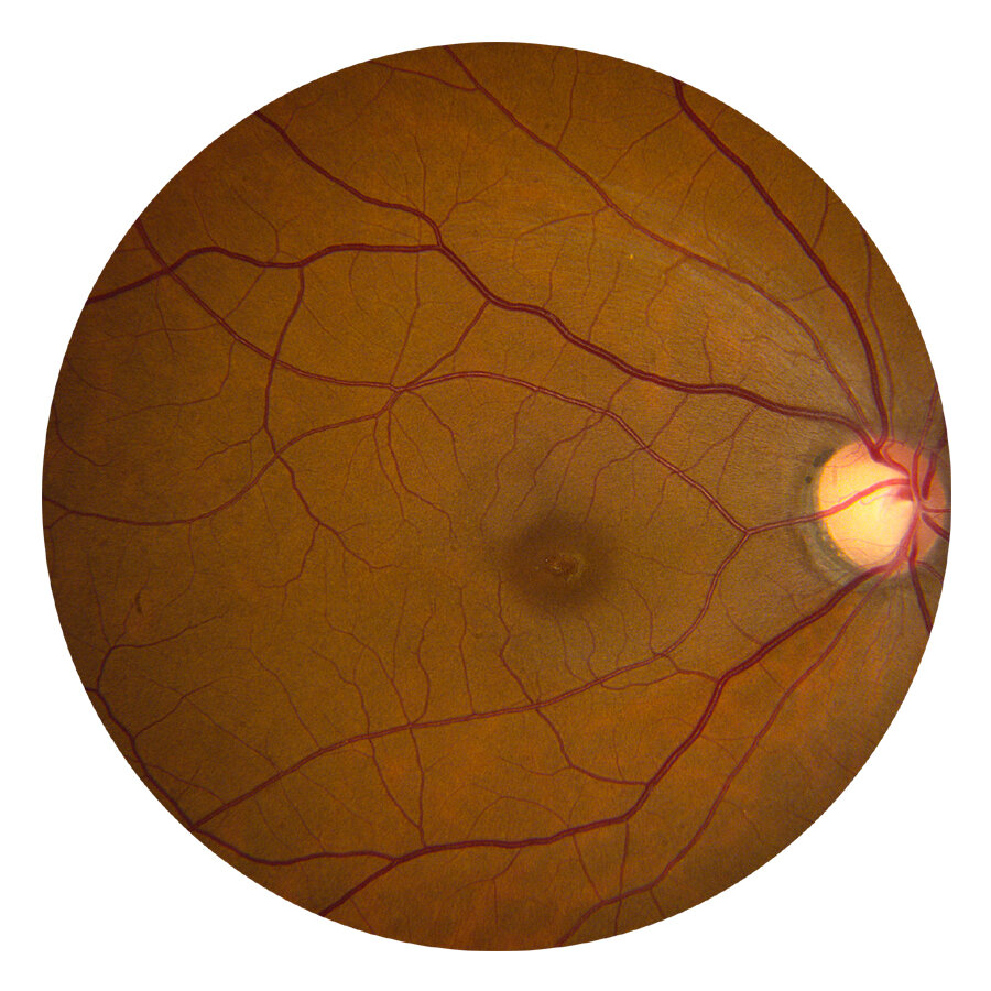 Rm Retinal Enrolling Clinical Trials — THE RETINA INSTITUTE