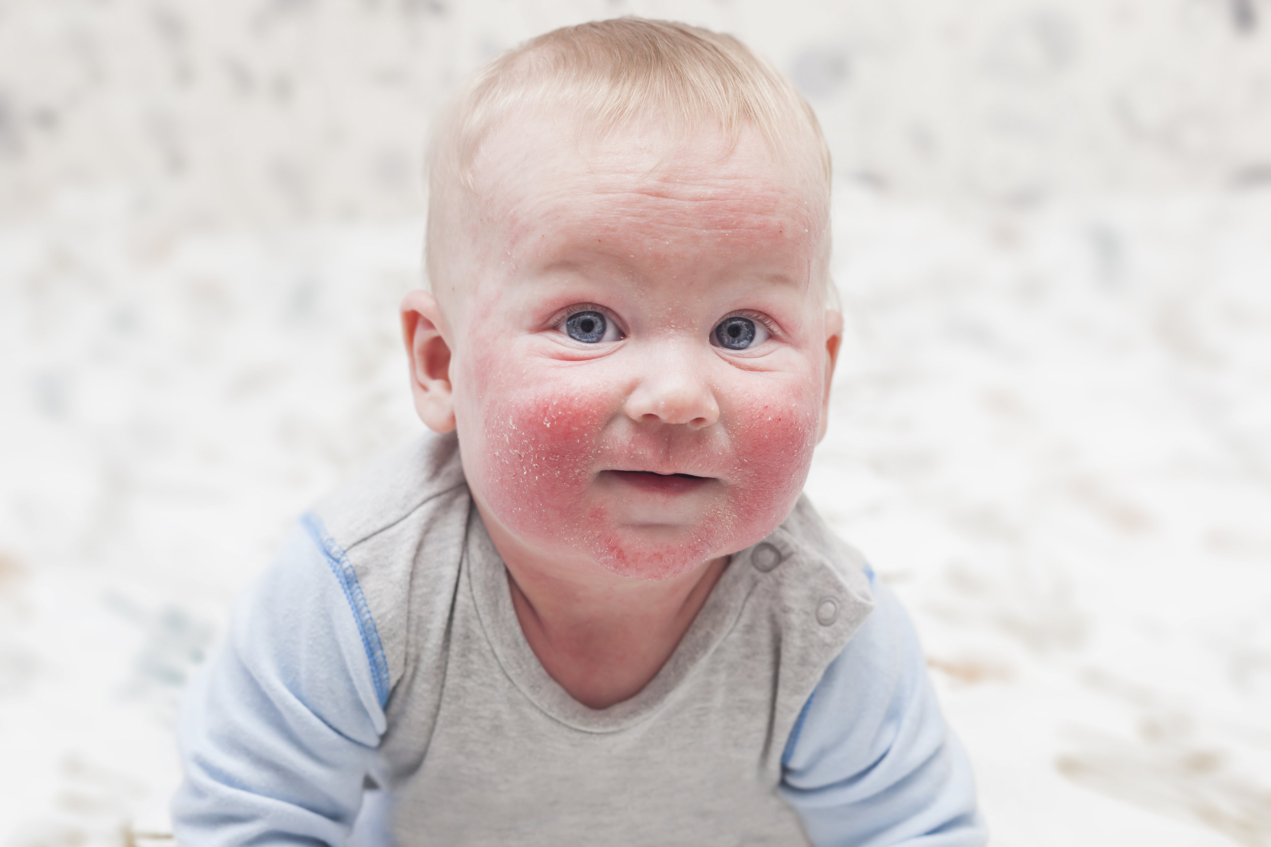 DERMATITIS ATOPICA Dermatosis que afecta a niños desde los primeros meses de vida que tiende autolimitarse o continuar en la vida adulta, los pacientes presentan piel seca, agravados por múltiples factores, mostrando lesiones en pliegues, mejillas intensamente pruriginosas, que afecta las superficies flexoras de codos y rodillas, piel cabelluda, la cara y tórax. Sin embrago el uso de medidas dermatológicas específicas y tratamiento adecuado, este padecimiento es bien controlado