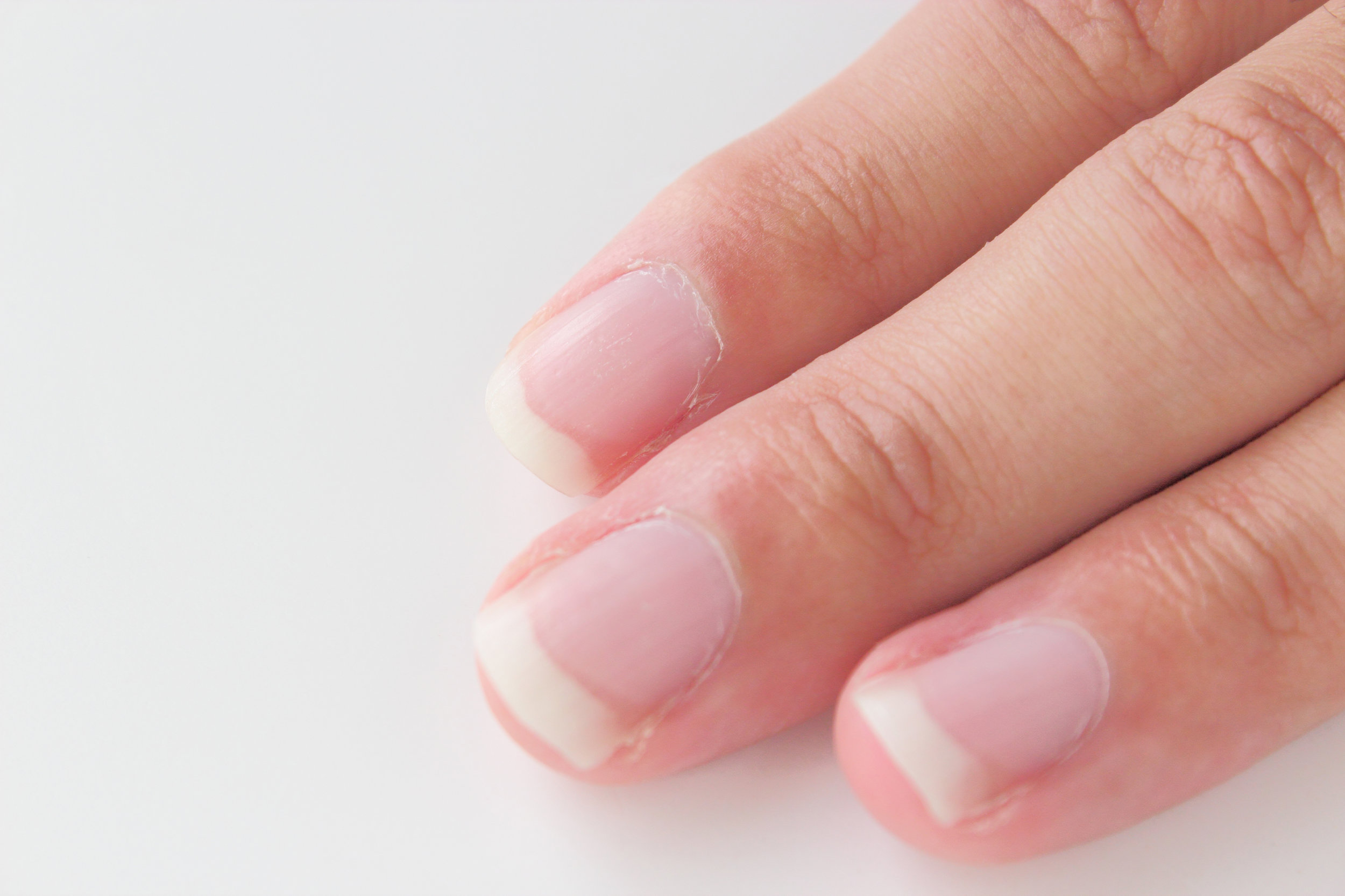 ENFERMEDAD DE UÑAS La dermatología además del cuidado de piel, trata múltiples patologías ungueales, como infecciones (hongos, bacterias), enfermedades inflamatorias, patologías mecánicas por trauma, tumores benignos, malignos, entre otros.
