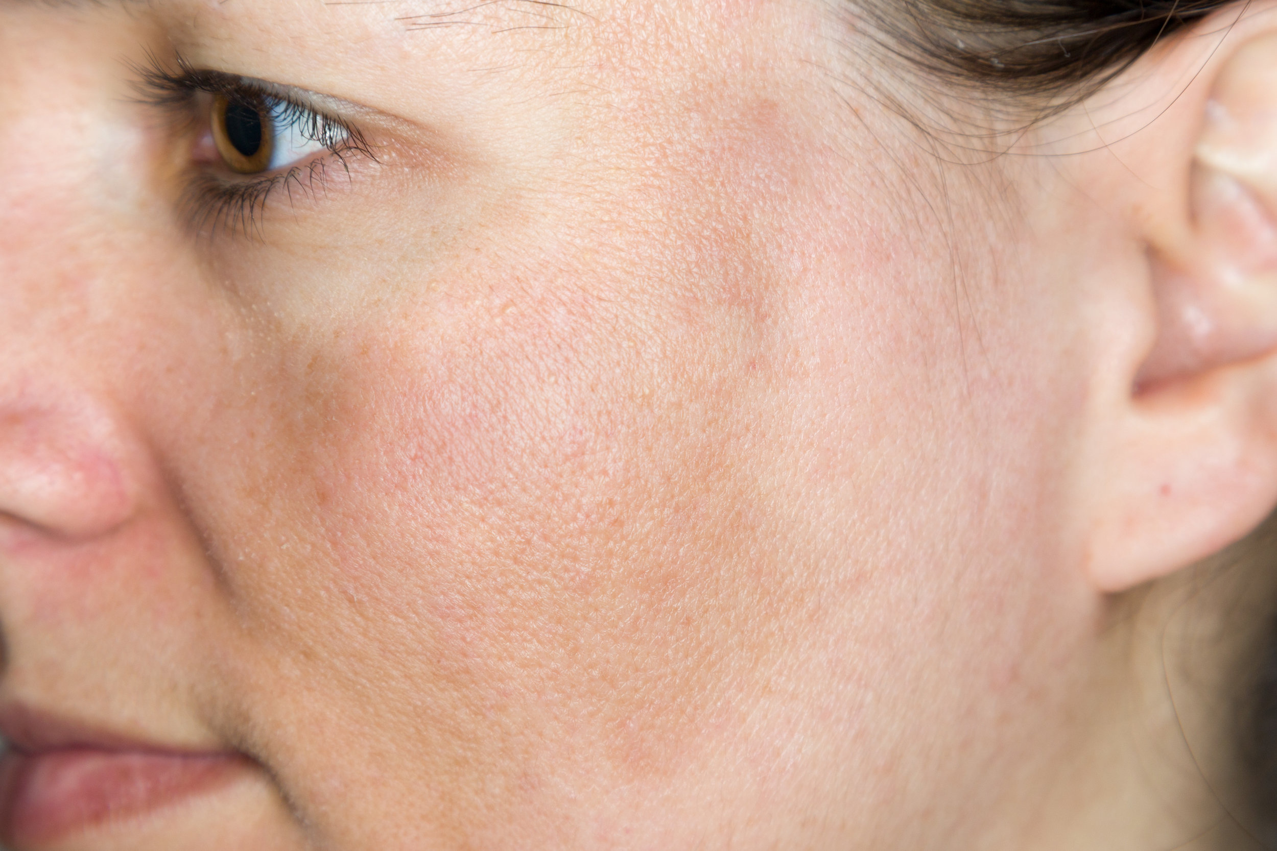 MELASMA Enfermedad pigmentaria adquirida y crónica de la piel, caracterizada por manchas café en cara de predominio en frente, mejillas y dorso de la nariz, este padecimiento afecta más a mujer, sin embargo también puede presentarse en hombres, provocando alteraciones cosméticas importante. El tratamiento consiste en diferentes protocolos con resultados exitosos.