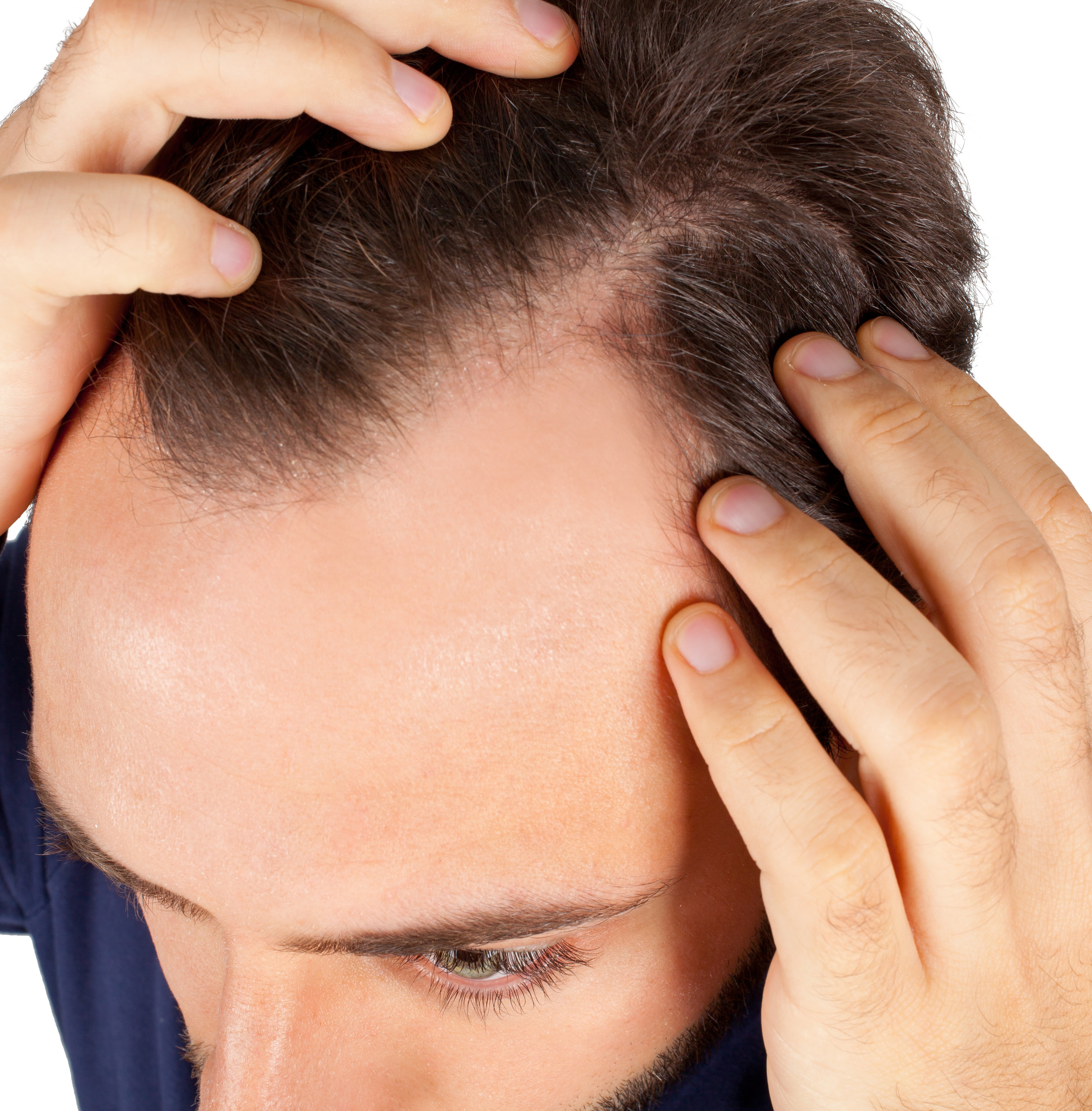 ALOPECIA Alteración de la piel cabelluda, con perdida progresiva de los folículos pilosos, por diferentes causas, el factor hormonal es el más común afectando mujeres y hombres. Debe realizarse un interrogatorio y estudio completo de cada paciente para poder diferenciar entre todos los tipos de alopecia y dar el tratamiento más adecuado.