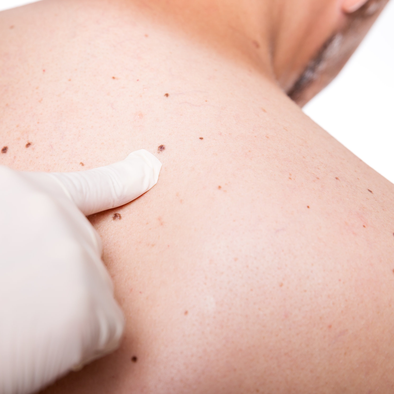CANCER DE PIEL El cáncer cutáneo es el más frecuente, secundario al daño por la radiación ultravioleta causando daños irreversibles a nivel celular, la prevención del mismo y la detección temprana del cáncer de piel puede evitar tratamientos agresivos y transformación maligna de lesiones conocidas como “ pre cáncer”.