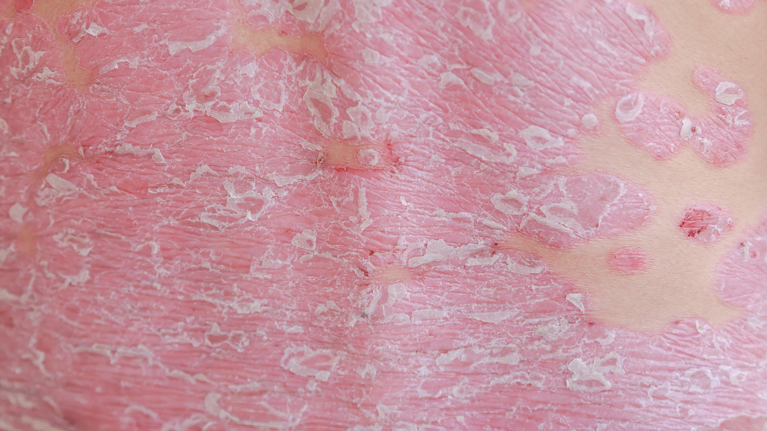PSORIASIS Enfermedad inflamatoria crónica de origen inmunológico, que pertenece al espectro de dermatosis eritemato-escamosa, afecta la piel, mucosas, y en ocasiones las articulaciones. Cuenta con una amplia variabilidad de lesiones que se clasifican con fines, pronósticos y terapéuticos.