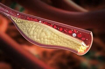 CHOLESTEROL