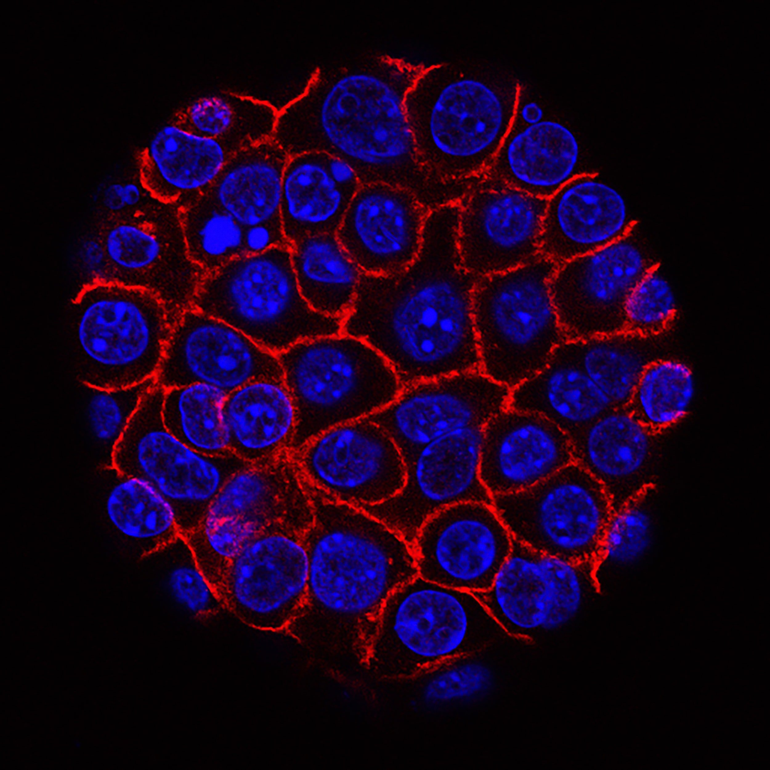 EARLY SIGNS OF PANCREATIC CANCER