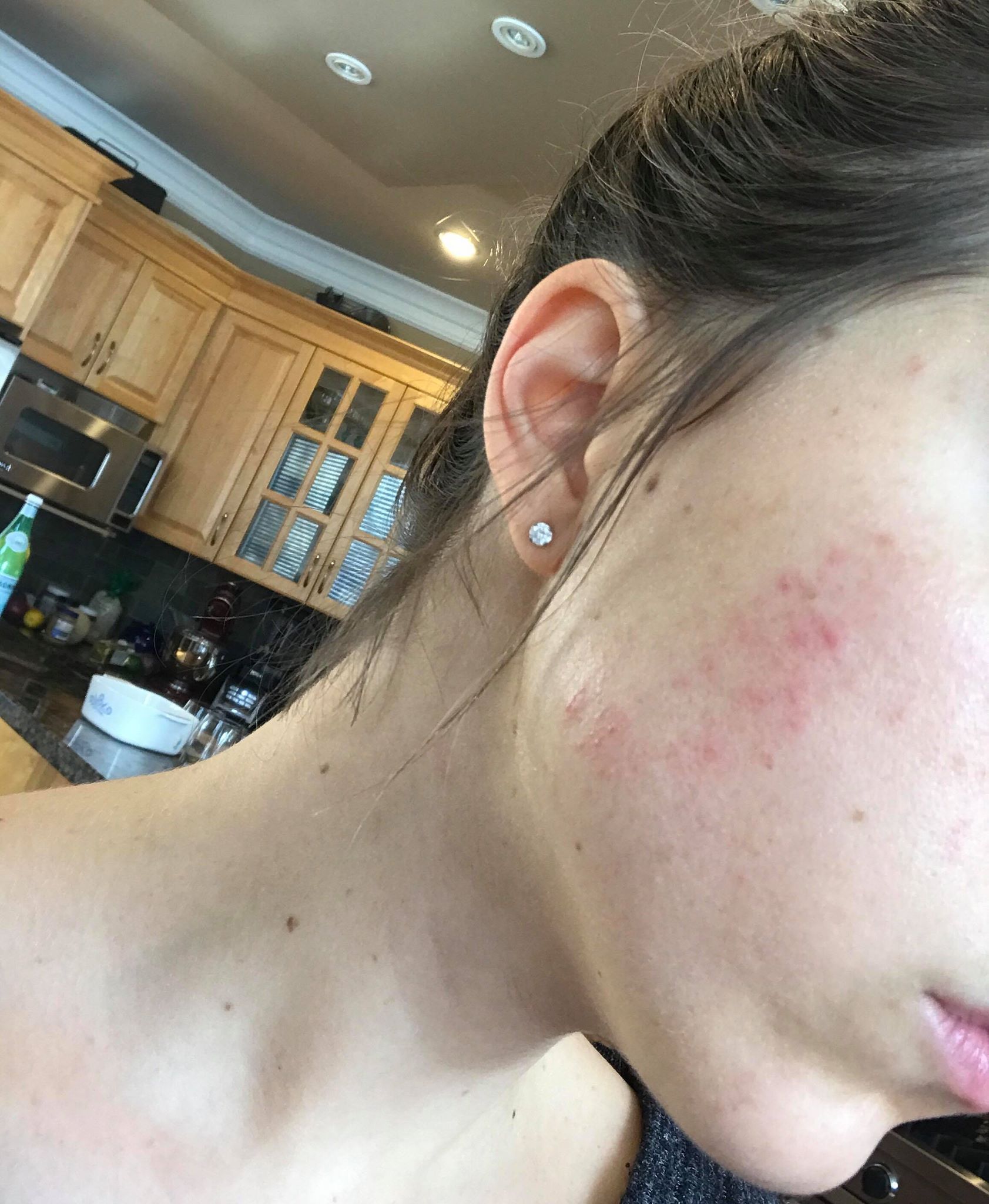 This was my skin mid July.