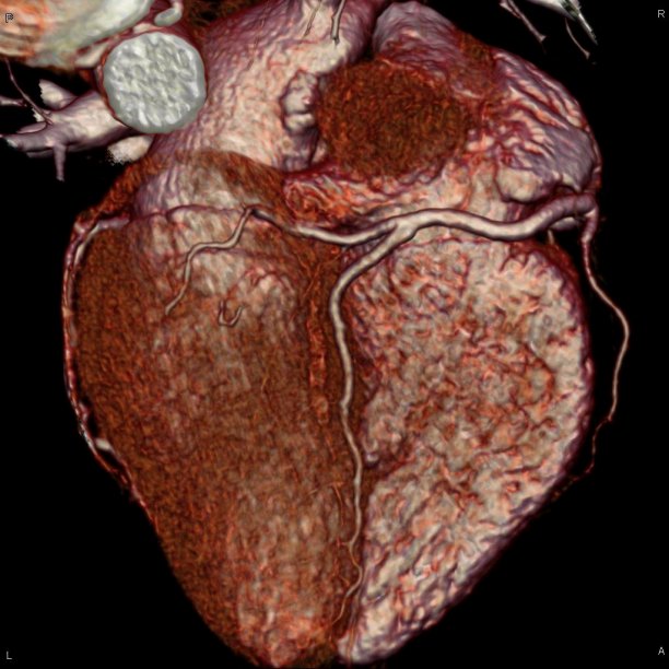 ct_definition_coronary cta.jpg