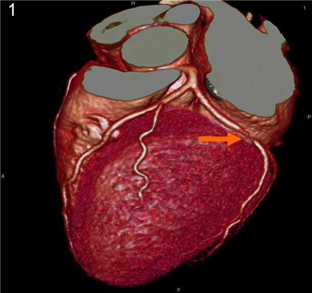 CTA- Heart- 3D Reconstruction.jpg