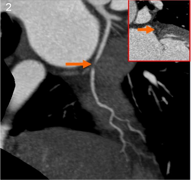 CTA- LCX Stenosis.jpg