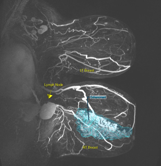 thumbnail_breast_MRI_13.jpg