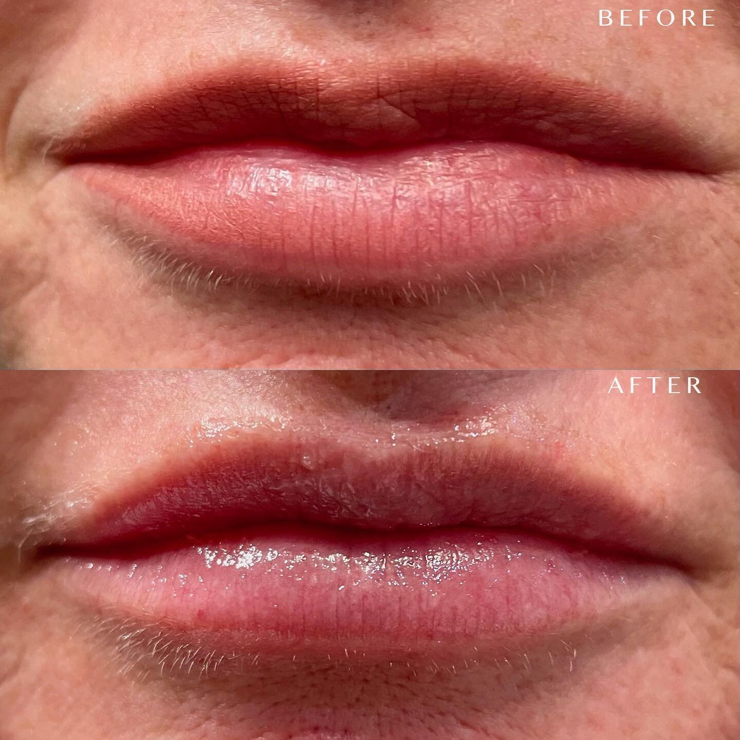 This patient wanted a subtle lip, I used Kysse 💋

Lips done by @babyfacellc.barbara

#lips #lipfiller #lipinjections #lipbeforeandafter #subtlelips #scottsdalebotox #scottsdaleinjector #azmedspa #booknow #linkinbio