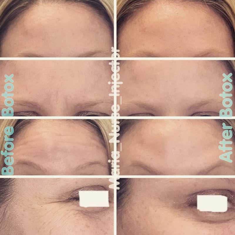 scottsdale botox to reduce forehead wrinkles