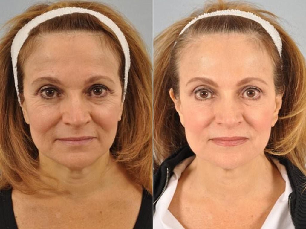 botox-before-after.jpg