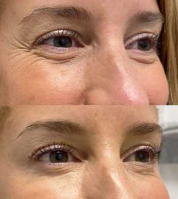 botox-for-crows-feet-before-after.jpg