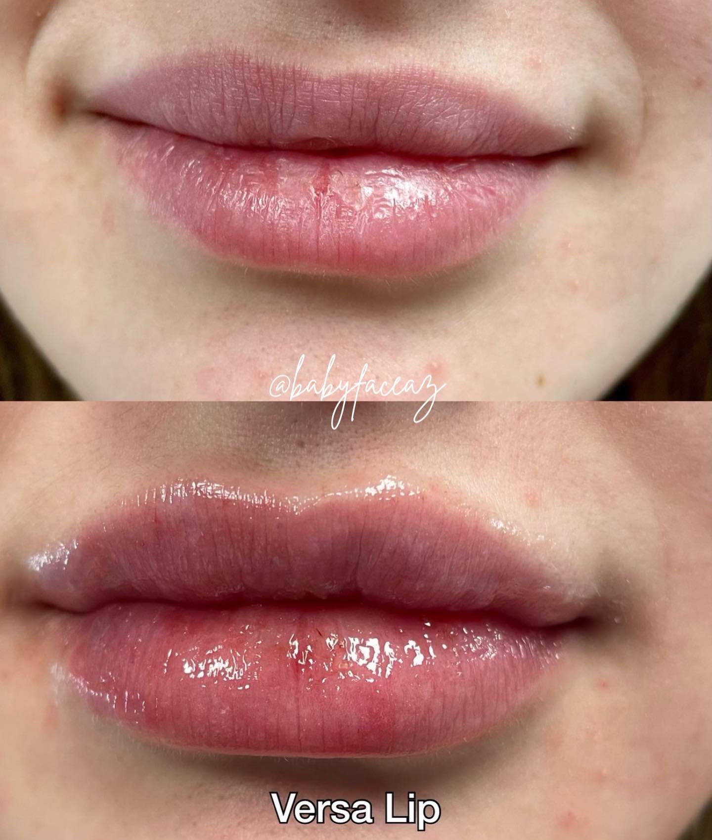 Versa-lip-fillers-scottsdale.jpg