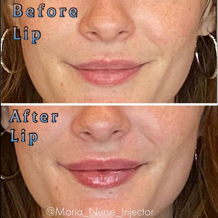 scottsdale lip filler restores plump youthful lips