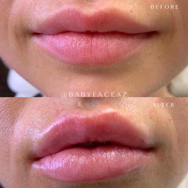 get sexy lips with lip filler in Scottsdale