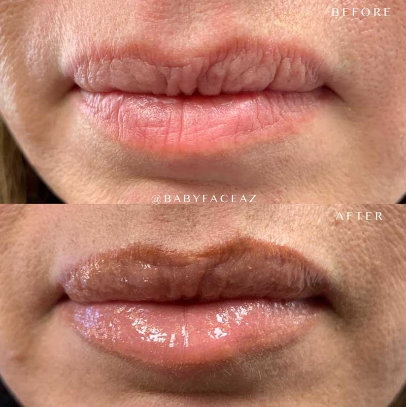 scottsdale lip filler is great for aging lips