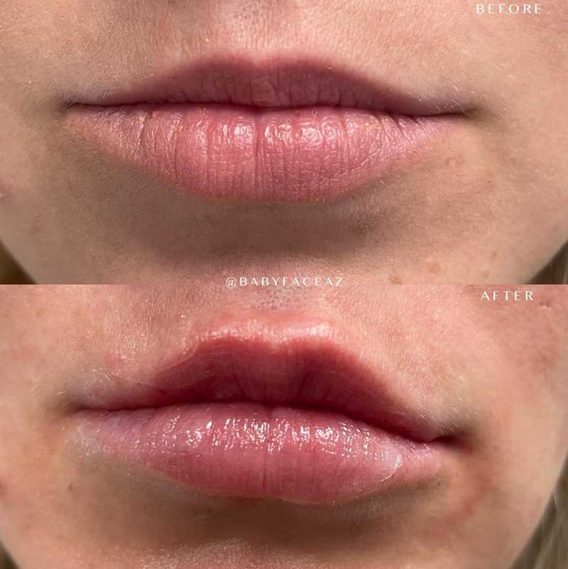 the perfect pout with lip filler in scottsdale