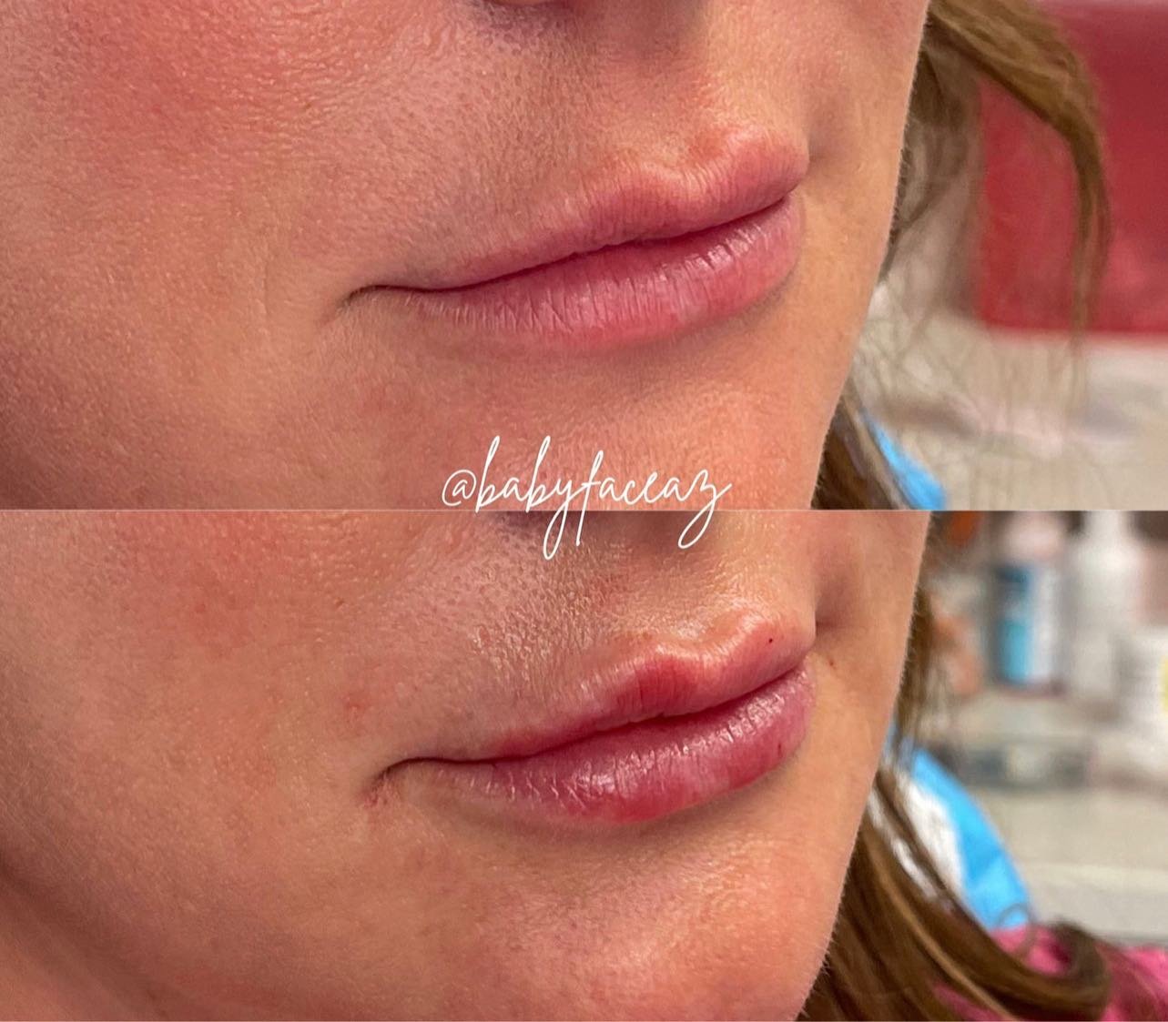 before and after lip filler Scottsdale