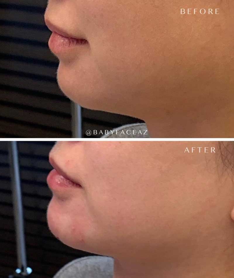Shape chin with dermal filler treatment in Scottsdale AZ