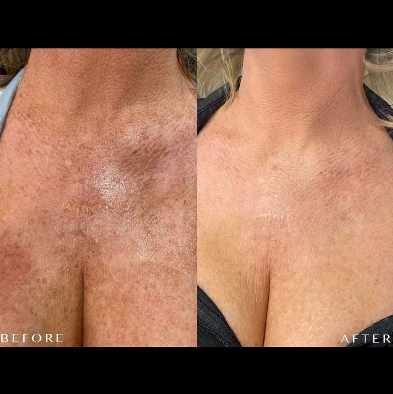 Reduce sun spots on chest with dermal fillers in Scottsdale!