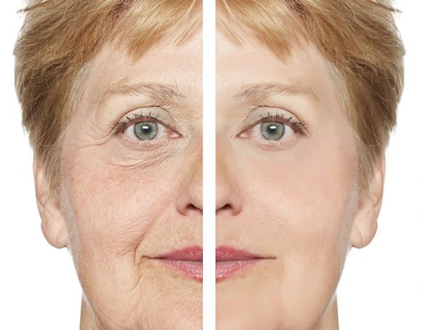 reduce sings of aging with dermal filler at BabyFace Scottsdale Med Spa