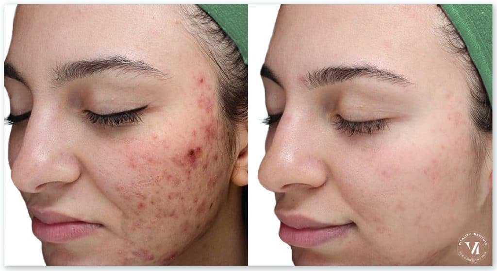 chemical peel before and after - for acne