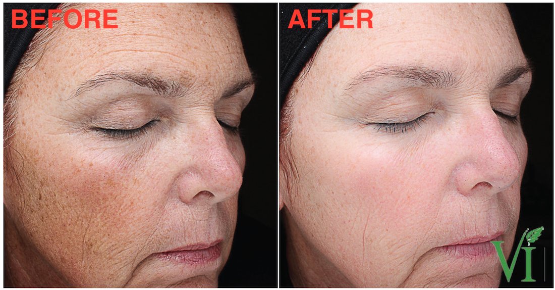 chemical peel before and after - for sunspots