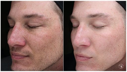 mens chemical peel before and after photo