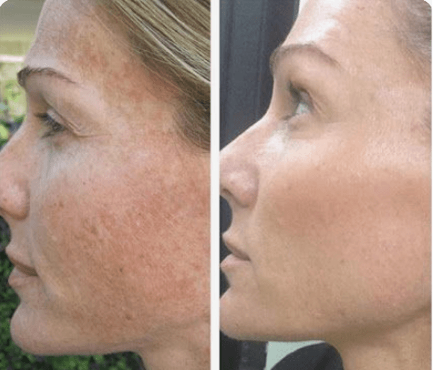  before and after photo of chemical peel for sun damaged skin