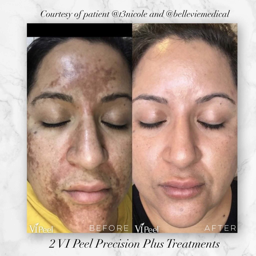  before and after photo of chemical peel for melasma