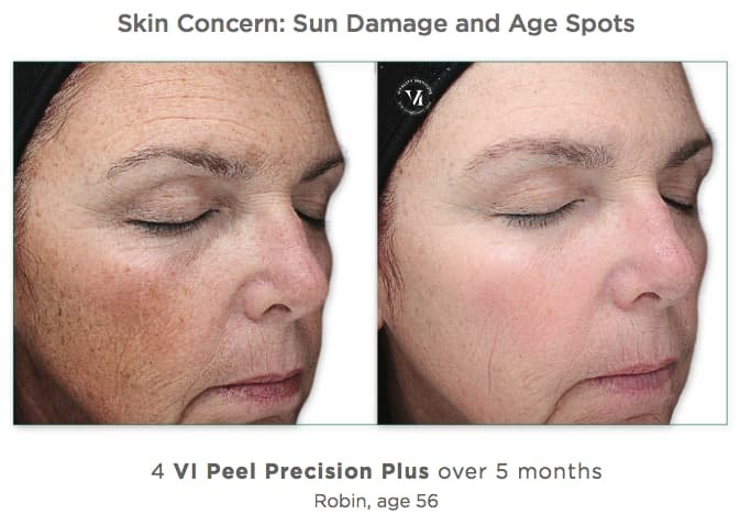  before and after photo of chemical peel for sun damaged skin and age spots