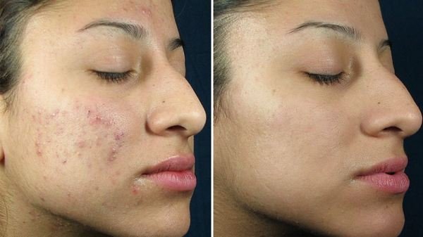  before and after photo of chemical peel for acne