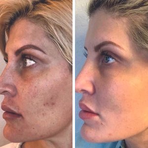  before and after photo of chemical peel for clear radiant skin