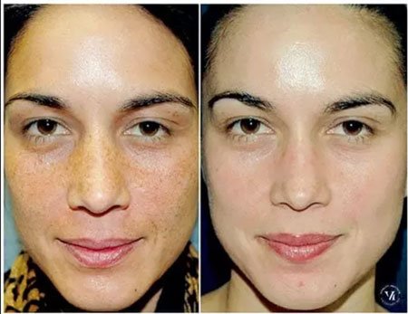  before and after photo of chemical peel for spots