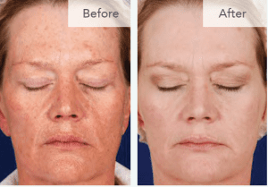  before and after photo of chemical peel for age spots