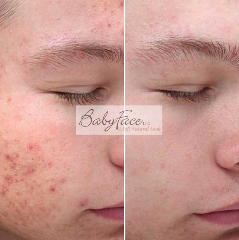  before and after photo of chemical peel for acne