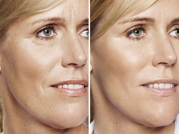 aquagold before and after for eye wrinkles and fine lines