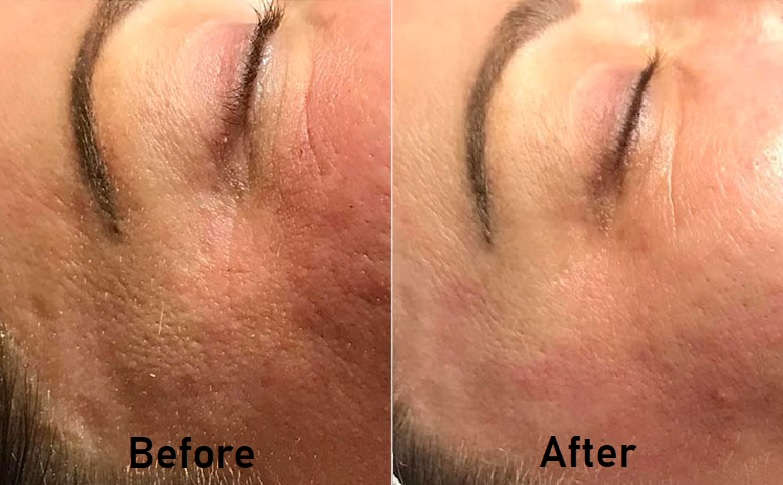 aquagold before and after around eyes