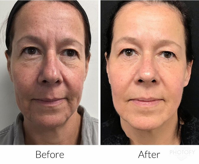 amazing aquagold before and after for wrinkles and radiant glow