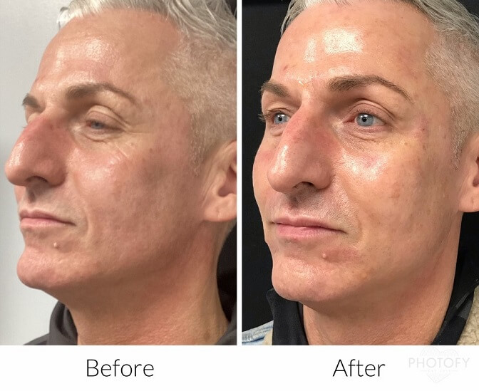aquagold before and after on man for smooth glowing skin
