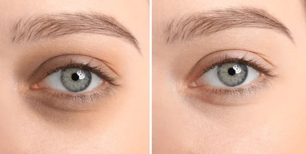 Dark Circles Under the Eyes: The 3 Types, and How to Reduce Them at BabyFace MedSpa