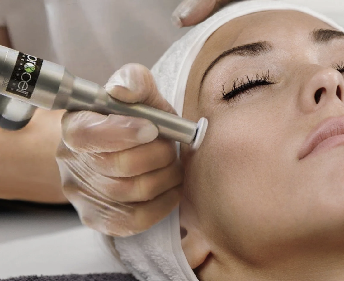 ProCell Microchanneling in Scottsdale: Refresh Your Skin from Within