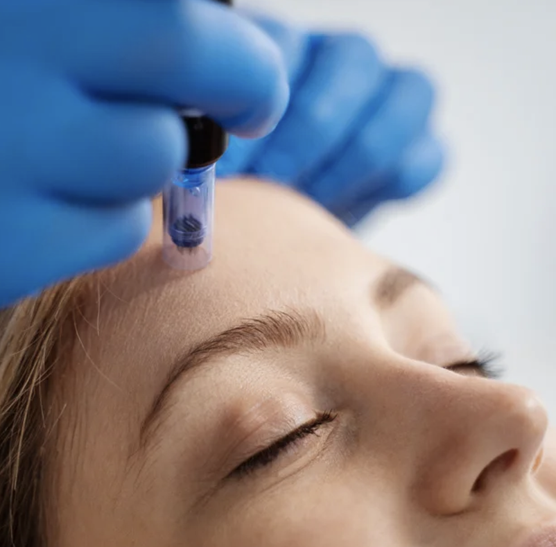 PDGF Meets Microneedling: Amplified Skin Regeneration in Scottsdale