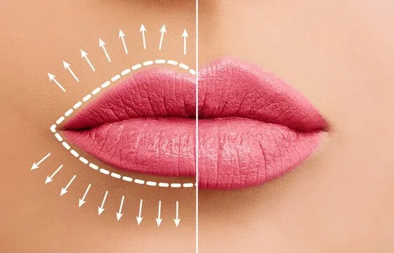 Lip Filler in Scottsdale: A Natural, Conservative Approach