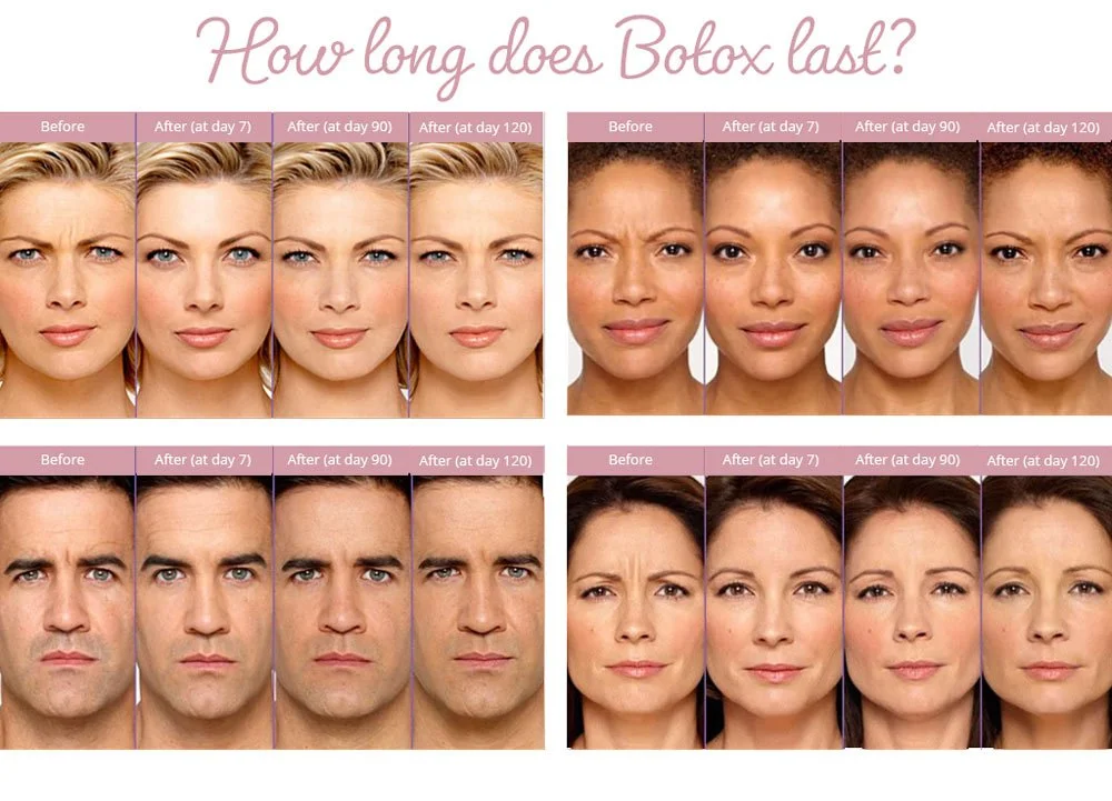 Learn how long Botox lasts & when to touch up - BabyFace MedSpa AZ ...